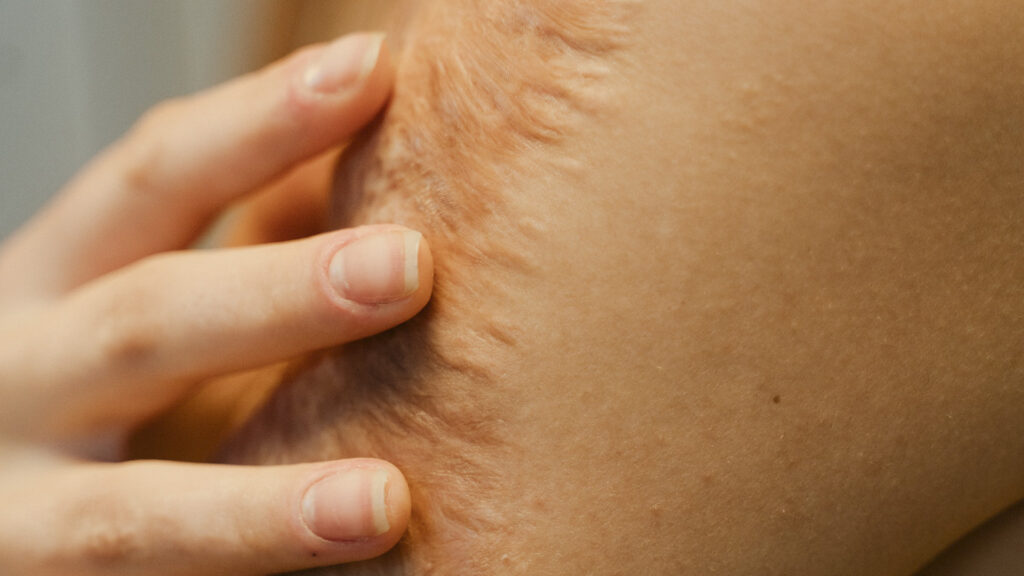 Studies Reveal Light Therapy May Accelerate Healing Of Burns