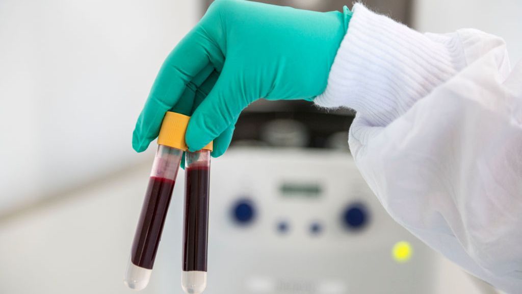 ‘Long COVID’ May Be Caused By Abnormal Blood Clotting