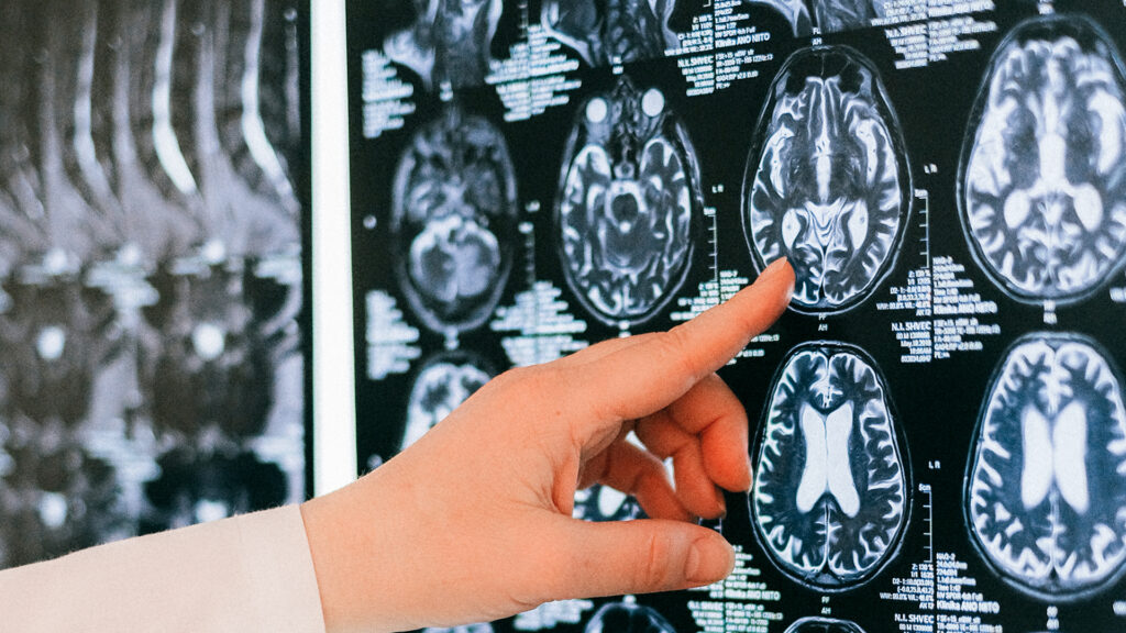 Genetic Risk Scores Can Aid Accurate Diagnosis Of Epilepsy