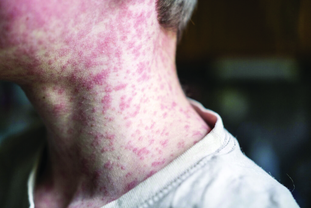 Summer’s coming, and data show measles cases are rising